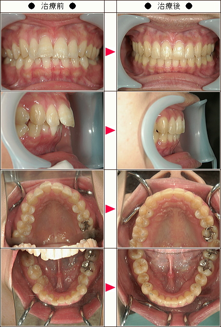 出っ歯矯正症例［Ｎ．Ｉ様　３４歳　女性］