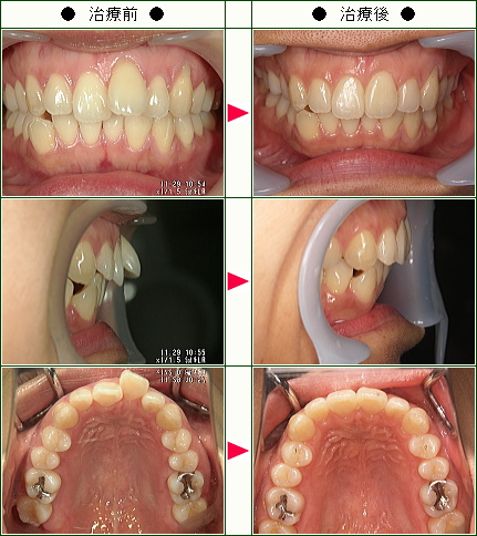 歯のデコボコ矯正症例(Ｎ．Ｉ様　３５歳　女性)