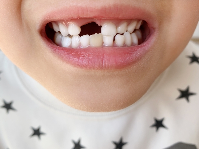 斜めに生えた乳歯は歯並びに影響する？