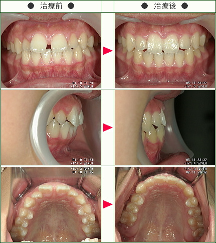 前歯のすきっ歯矯正症例(二宮様　１３歳　男性)