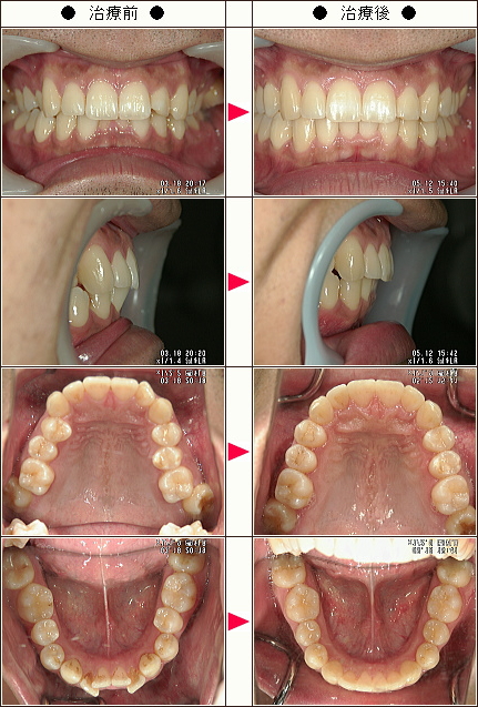 歯のデコボコ矯正症例［西様　２７歳　男性］