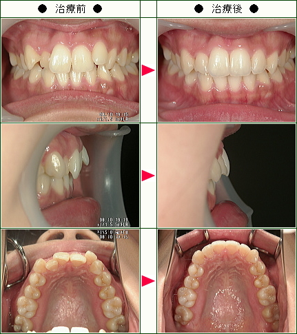 歯のデコボコ矯正症例(西田様　２２歳　女性)