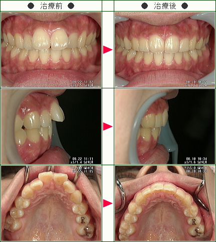 出っ歯矯正症例(Ｎ.Ｋ様　１９歳　女性)
