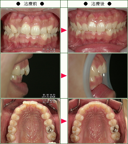 歯のデコボコ矯正症例(Ｎ・Ｋ様　２８歳　女性)