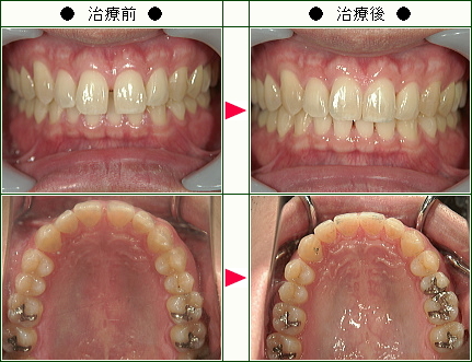 前歯のすきっ歯矯正症例(Ｎ.Ｋ様　３１歳　男性)
