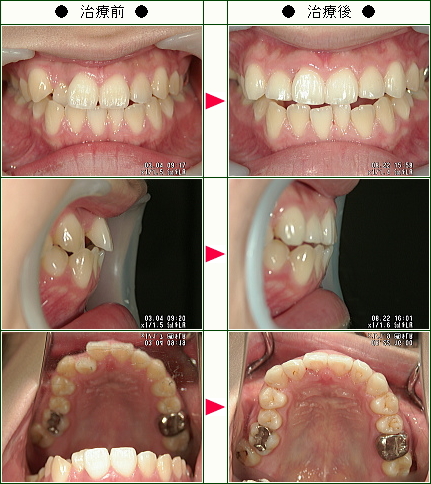 歯のデコボコ矯正症例(Ｎ・Ｍ様　２０歳　女性)