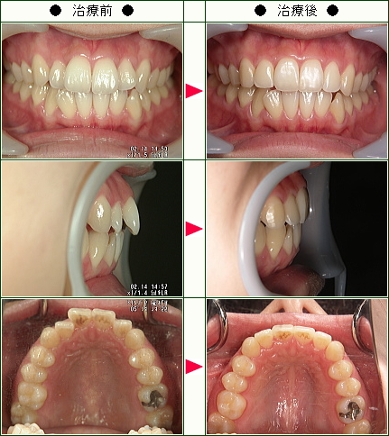 歯のデコボコ矯正症例(Ｎ・Ｍ様　２２歳　女性)