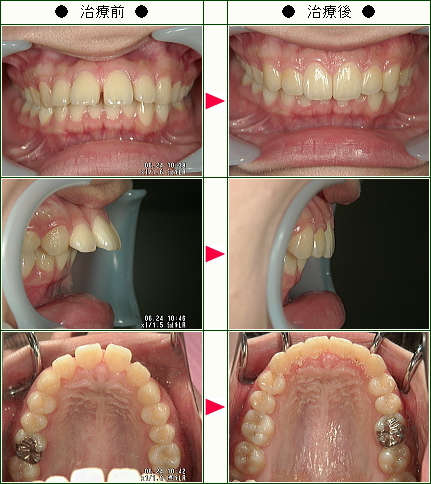 出っ歯矯正症例(Ｎ.Ｍ様　２２歳　女性)