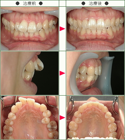歯のデコボコ矯正症例(Ｎ・Ｍ様　２７歳　女性)