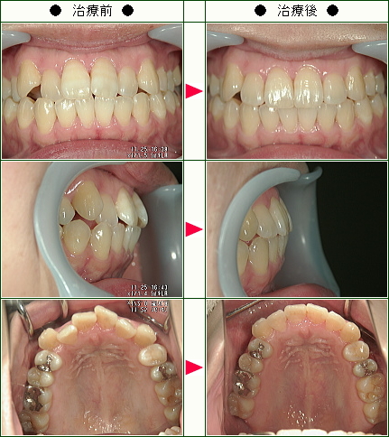 歯のデコボコ矯正症例(Ｎ・Ｍ様　３１歳　女性)