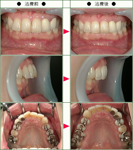 歯のデコボコ矯正症例(Ｎ.Ｍ様　３７歳　女性)