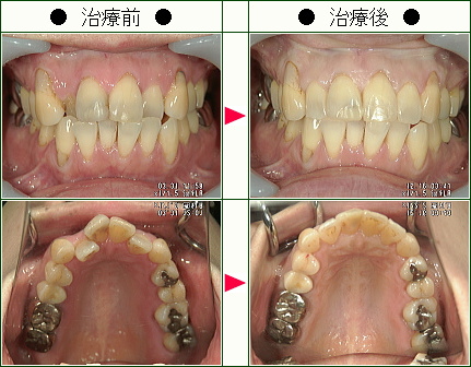 歯のデコボコ矯正症例(Ｎ.Ｍ様　５０歳　女性)