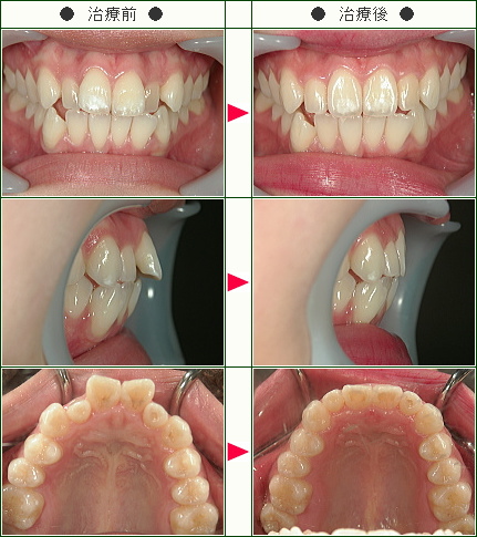 歯のデコボコ症例(Ｎ.Ｏ様　１８歳　女性)