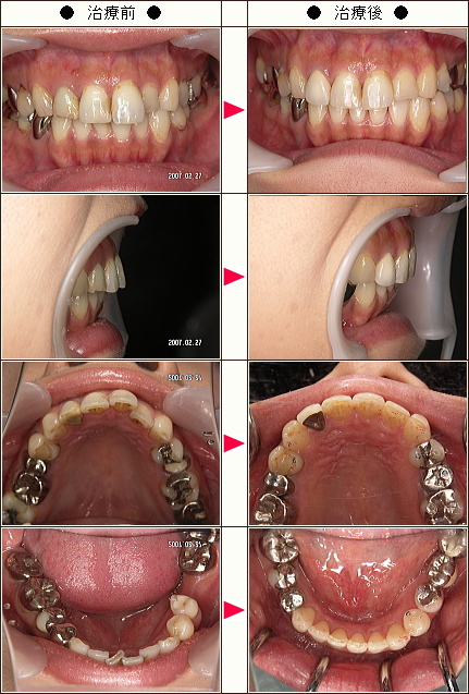 歯のデコボコ矯正症例［Norllys様　３５歳　女性］