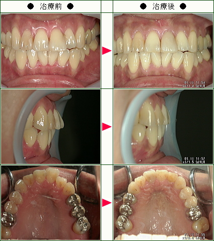 歯のデコボコ矯正症例(Ｎ．Ｓ様　３６歳　女性)