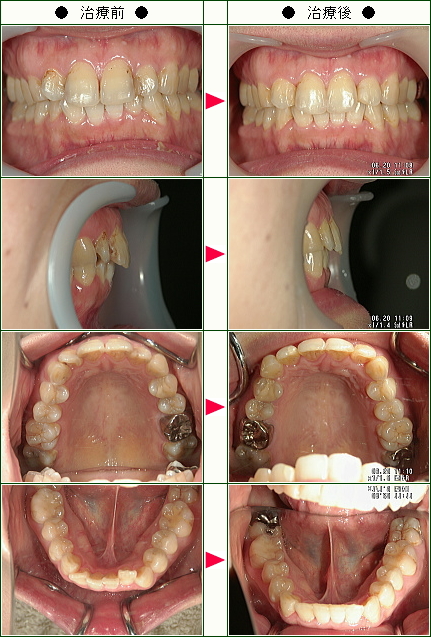 歯のデコボコ矯正症例(Ｎ.Ｓ様　３８歳　女性)