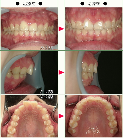 歯のデコボコ矯正症例(Ｎ・Ｔ様　２３歳　女性)
