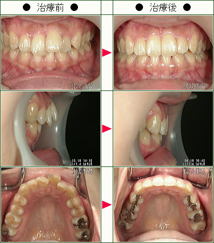 歯のデコボコ矯正症例(Ｎ・Ｔ様　２７歳　女性)