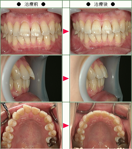 出っ歯矯正症例(Ｎ・Ｔ様　３８歳　女性)