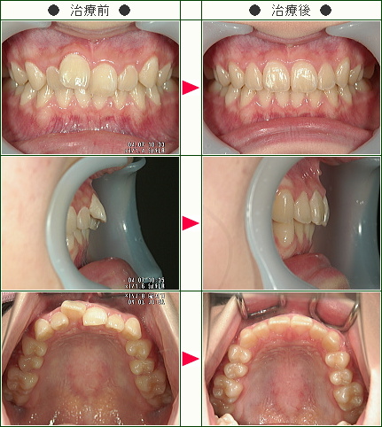 歯のデコボコ症例(Ｎ.Ｕ様　１５歳の娘の母　女性)