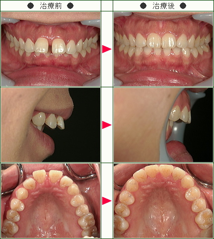 前歯のすきっ歯矯正症例(Ｎ．Ｕ様　３５歳　女性)