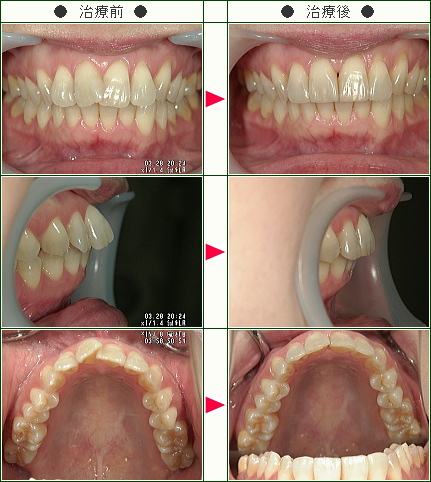 歯のデコボコ矯正症例(Ｎ・Ｕ様　４２歳　女性)