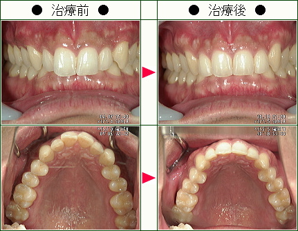 歯のデコボコ矯正症例(Ｎ．Ｙ様　４６歳　女性)