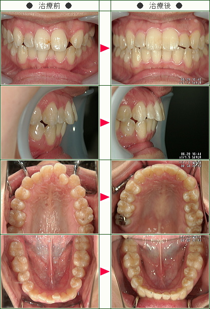 歯のデコボコ矯正症例(Ｏ様　２１歳　女性)