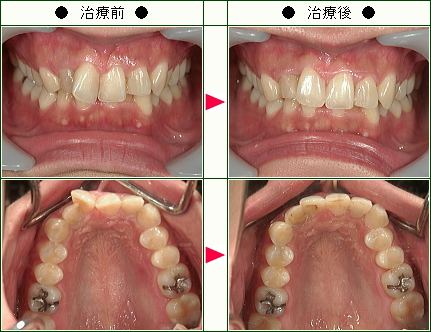 歯のデコボコ矯正症例(Ｏ様　２３歳　女性)