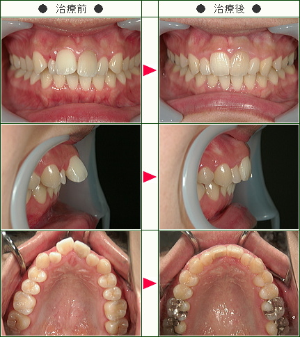 出っ歯矯正症例(Ｏ様　２４歳　女性)