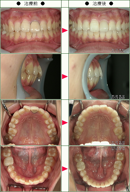 歯のデコボコ矯正症例(Ｏ様　３０歳　女性)