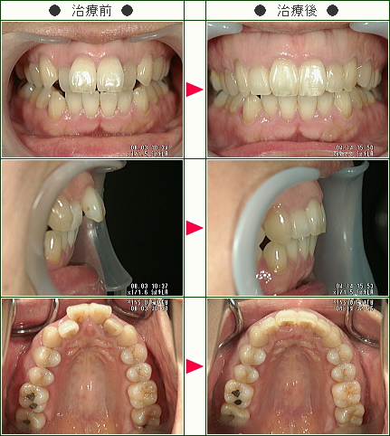 歯のデコボコ症例(Ｏ様　４９歳　女性)
