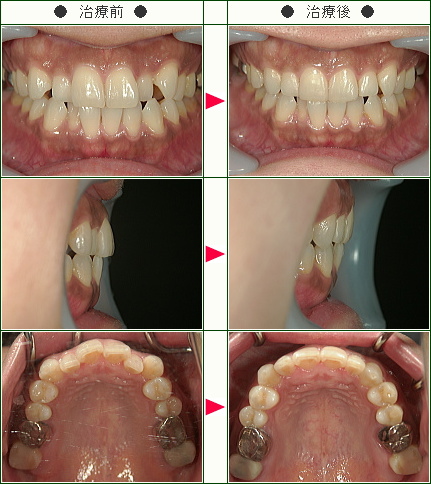 歯のデコボコ矯正症例(尾林様　４２歳　女性)