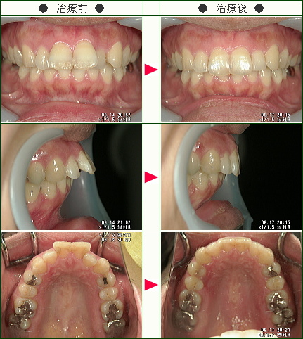 出っ歯矯正症例(Ｏ.Ｃ様　３９歳　女性)