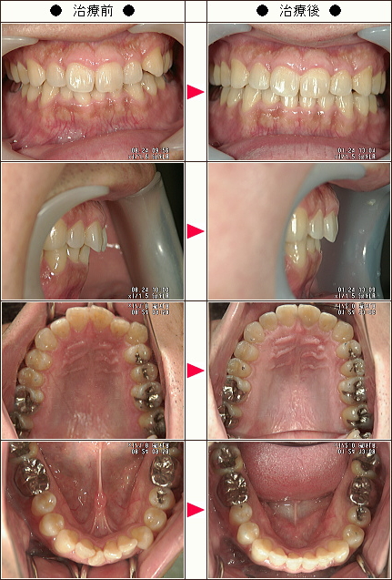 歯のデコボコ矯正症例［落合様　３８歳　男性］