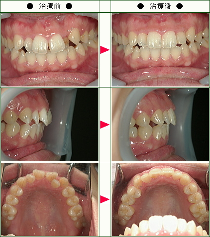 歯のデコボコ矯正症例(Ｏ.Ｅ様　２５歳　女性)