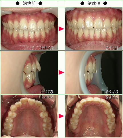 歯のデコボコ矯正症例(小川様　２４歳　女性)