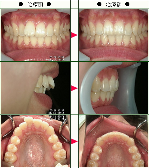 出っ歯矯正症例(荻野様　１８歳　女性)