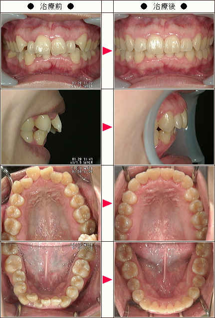 歯のデコボコ矯正症例［大の様　２８歳　女性］