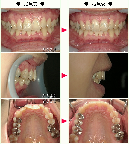 歯のデコボコ矯正症例(岡崎様　３１歳　女性)