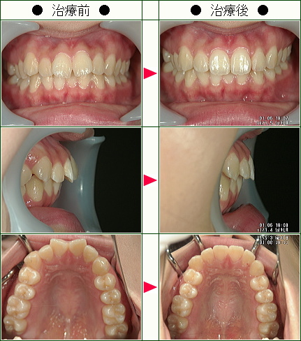 歯のデコボコ矯正症例(奥田様　１８歳　女性)