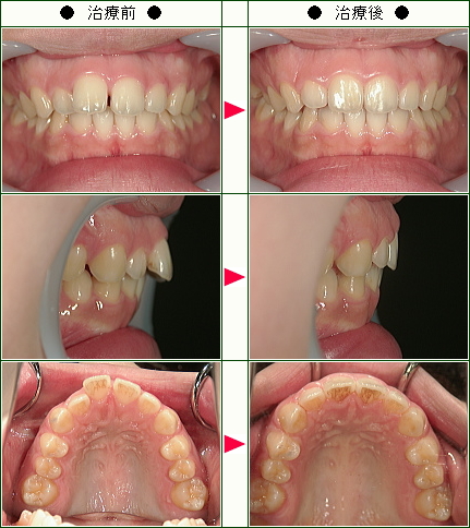 歯のデコボコ矯正症例(Ｏ．Ｎ様　１９歳　女性)