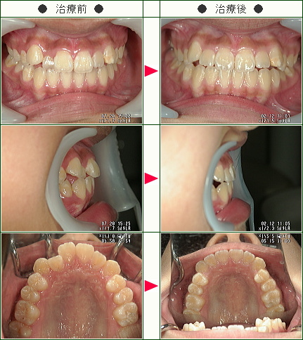 歯のデコボコ症例(小野様　１２歳　女性)