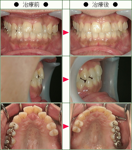 歯のデコボコ矯正症例(大濱様　４１歳　女性)