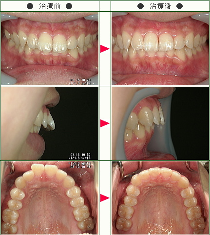 出っ歯矯正症例(オオクリ様　１７歳　女性)