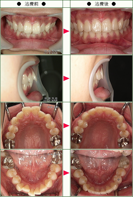 歯のデコボコ矯正症例(大澤様　２１歳　女性)