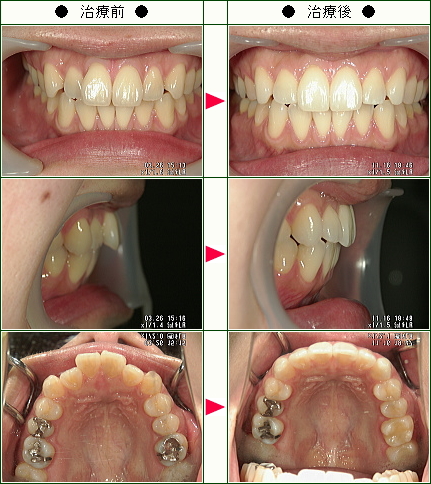 歯のデコボコ矯正症例(太田様　２９歳　女性)