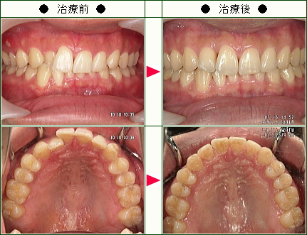 歯のデコボコ矯正症例(大山様　２９歳　男性)