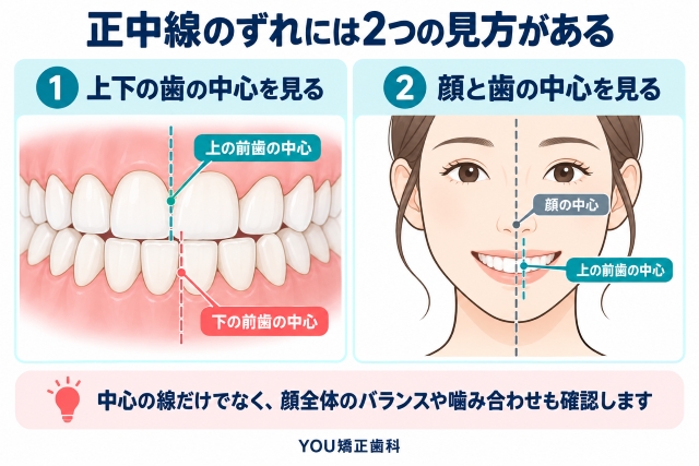 正中線のずれには2つの見方がある