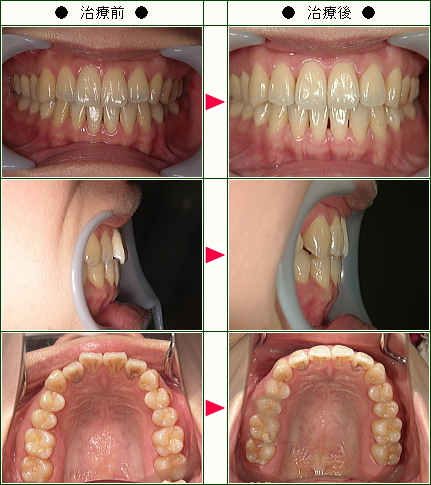 歯のデコボコ矯正症例(Ｏ．Ｓ様　３１歳　女性)